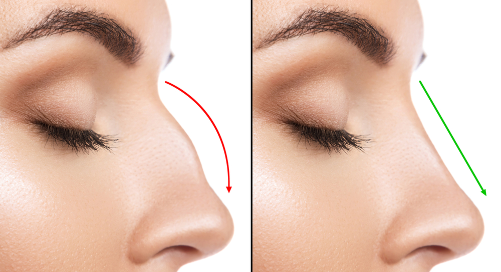 Comparison,Of,Female,Nose,After,Plastic,Surgery