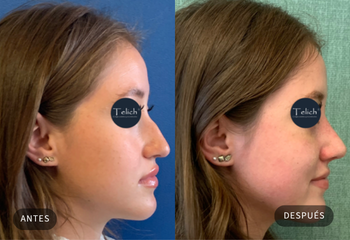 Caso real de rinoplastia 4 — comparativa antes y después, con consentimiento del paciente · Dr. Telich, CDMX