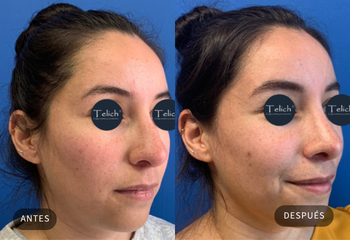 Caso real de rinoplastia 3 — comparativa antes y después, con consentimiento del paciente · Dr. Telich, CDMX