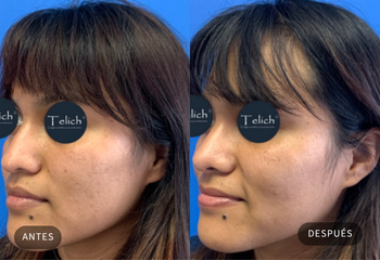 Caso real de rinoplastia 5 — comparativa antes y después, con consentimiento del paciente · Dr. Telich, CDMX