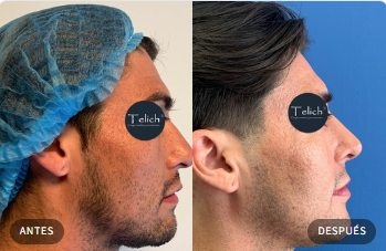 Caso real de rinoplastia 2 — comparativa antes y después, con consentimiento del paciente · Dr. Telich, CDMX