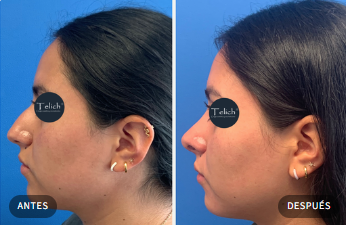 Caso real de rinoplastia 1 — comparativa antes y después, con consentimiento del paciente · Dr. Telich, CDMX
