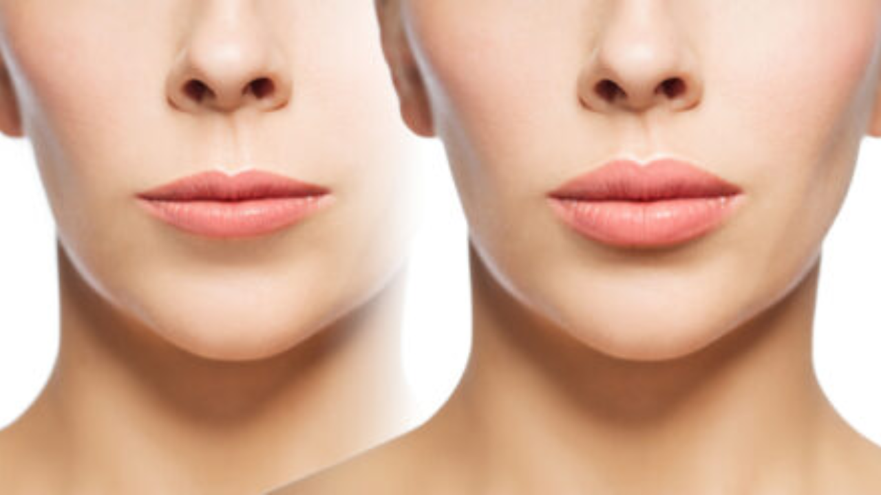 Lip Lift: Eleva tu sonrisa y mejora tu confianza.