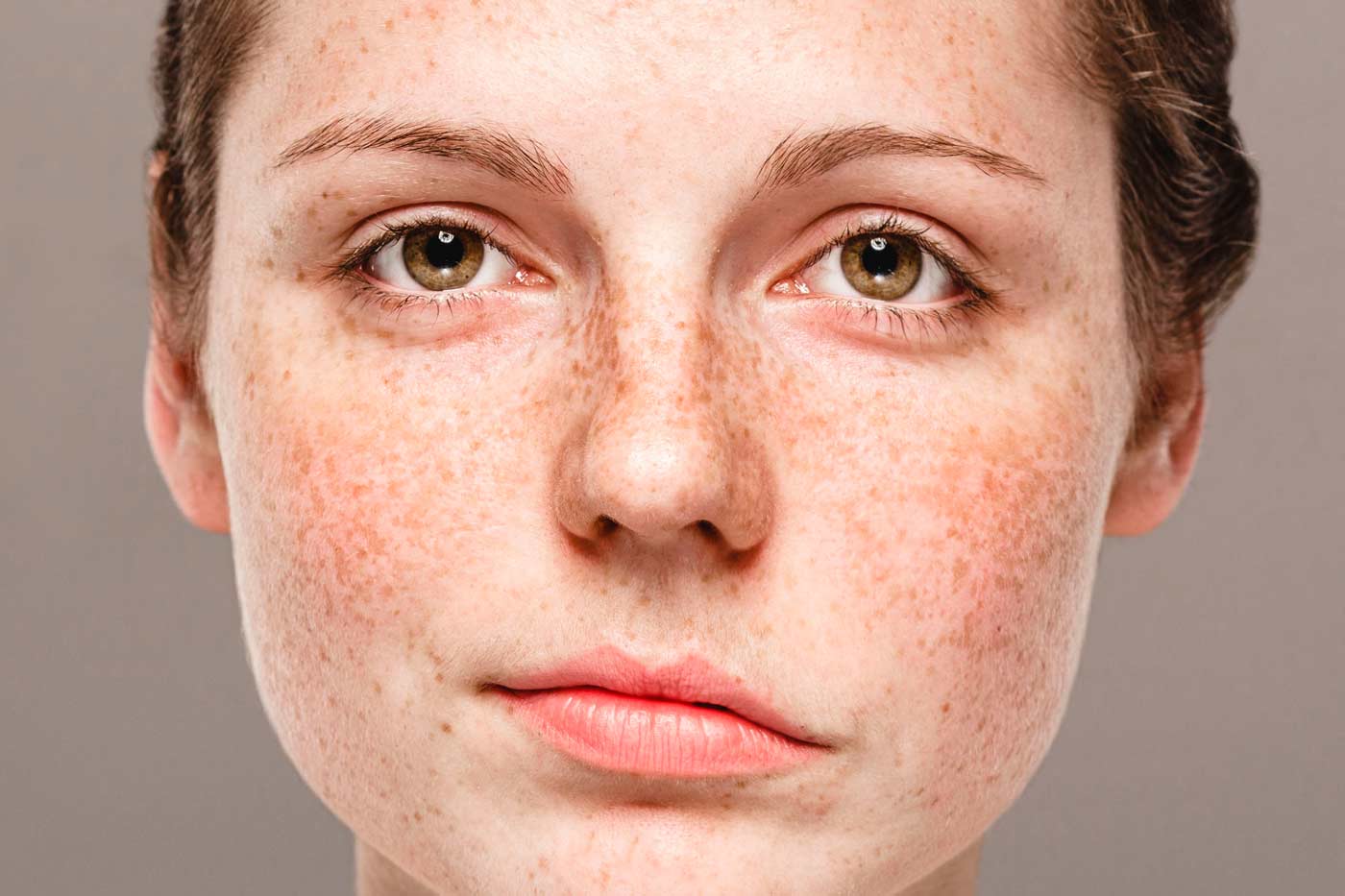 Tratamiento de la parálisis facial según el tiempo de evolución